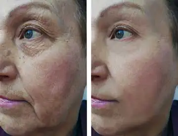 Skin Booster Aesthetics Treatment before and after