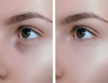 Tear Trough Aesthetics Treatment before and after