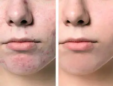 Acne Aesthetics Treatment before and after