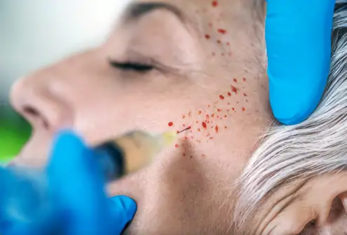 PRP Treatment to the Face