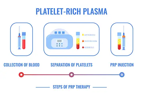 PRP Treatment illustration