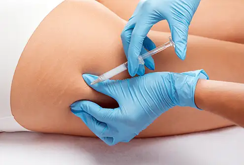 Thigh Fat Dissolving Injections Treatment